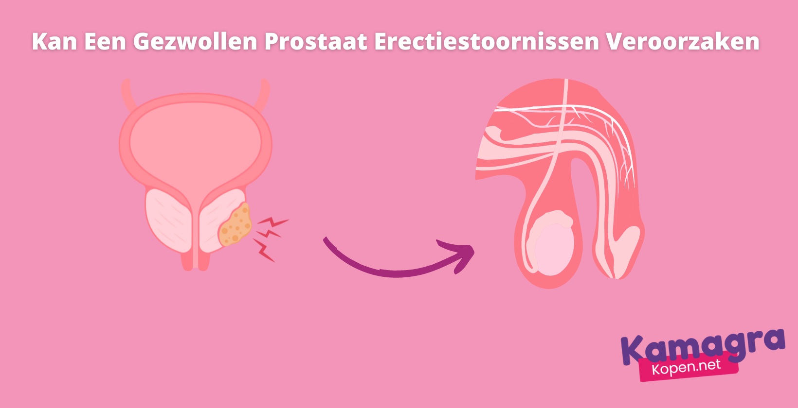 Kan een gezwollen prostaat erectiestoornissen veroorzaken